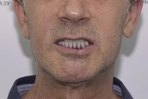Восстановление зубов методом All-on-4 - после
