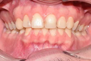 Профессиональная гигиена и отбеливание зубов, фото до