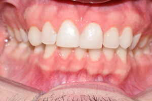 Профессиональная гигиена и отбеливание зубов, фото после