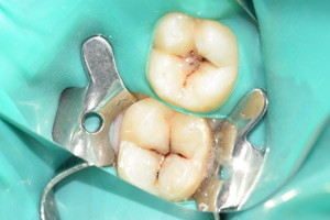 Лечение кариеса жевательных зубов, фото до