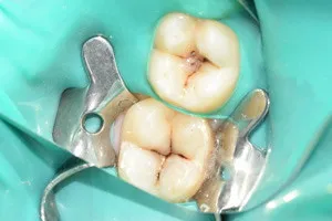 Лечение кариеса жевательных зубов, фото до
