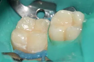 Лечение кариеса жевательных зубов, фото после