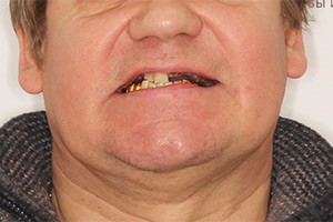 Однофазная имплантация верхней челюсти