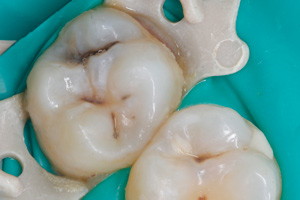 Лечение кариеса жевательного зуба, фото до