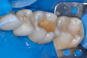 Лечение кариеса трех жевательных зубов, фото до