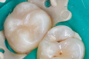 Лечение кариеса жевательного зуба, фото после