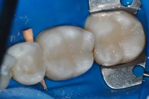 Лечение кариеса трех жевательных зубов, фото после
