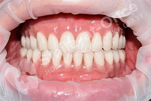 Однофазная имплантация зубов на 2-х челюстях