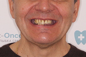 Имплантация верхней челюсти и жевательных зубов