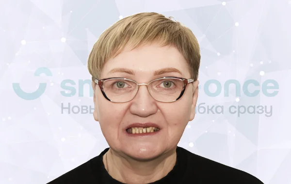 Восстановление зубов методом Pro Arch на 4 имплантах после