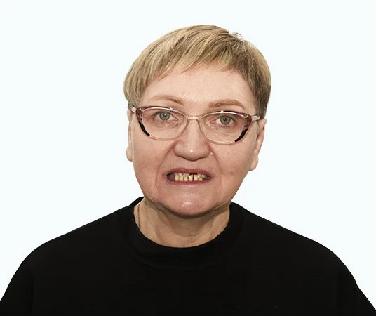 Фото до имплантации зубов пациентке