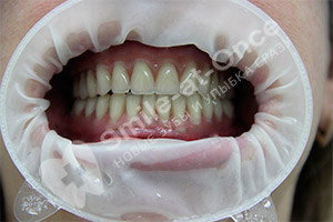 Комплексная базальная имплантация зубов