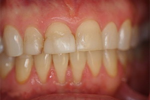 Улучшение эстетики передних зубов винирами