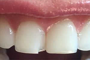 Восстановление скола зуба винирами