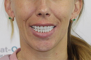Восстановление зубов комплексом базальных имплантов