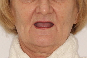 BASAL COMPLEX при полной адентии