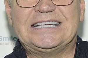 Импланатция ALL-ON-6 на 6 имплантах Zygoma