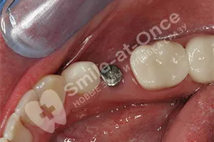 Установка коронки на зубной имплант
