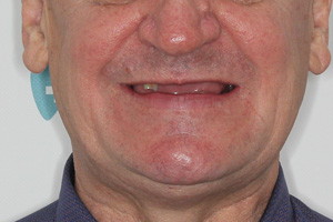 All-on-6 для нижней челюсти  All-on-6 с имплантами Zygoma для верхней челюсти
