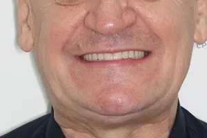 All-on-6 для нижней челюсти  All-on-6 с имплантами Zygoma для верхней челюсти, фото после