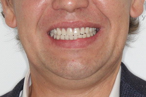 Basal Complex для нижней челюсти при пародонтозе - после