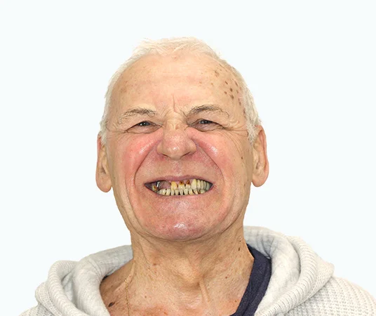 Фото до восстановления отсутствующих зубов