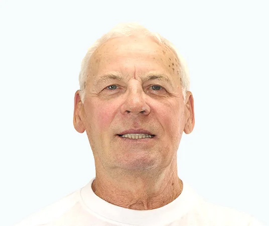 Фото после имплантации отсутствующих зубов