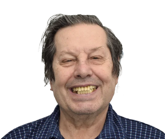 До имплантации всех зубов all-on-4