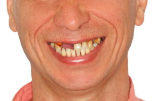 Восстановление верхней челюсти на имплантах Oneway Biomed - до