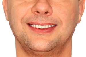 Базальная имплантация верхней челюсти при острой атрофии костной ткани