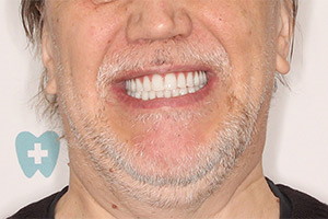 Восстановление всех зубов за 3 дня