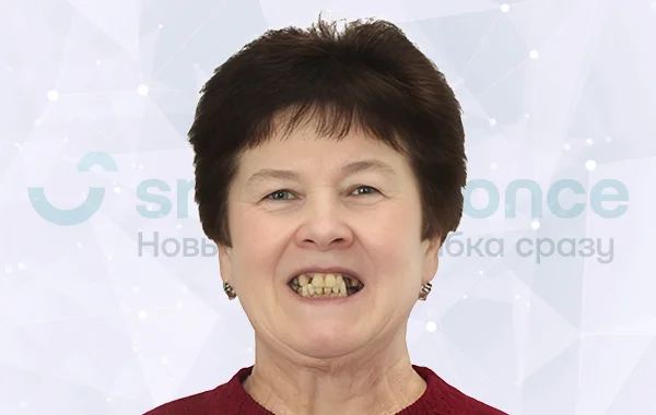 Имплантация всех зубов all-on-4 Имплантация всех зубов all-on-4 Nobel Biocare до