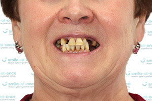Все зубы All-on-4 на имплантах Nobel Biocare ДО