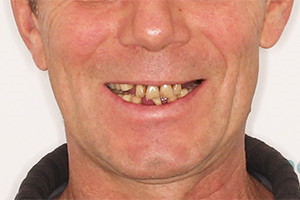Замена зубных мостов (Однофазная имплантация)