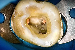 Лечение пульпита зуба с 4 каналами под микроскопом ДО