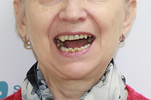 Восстановление разрушенных зубов имплантацией