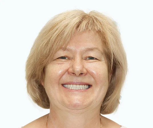 После имплантации зубов