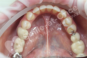 Имплантация и реставрация зубов