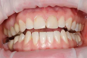 Художественная реставрация и чистка зубов, фото до