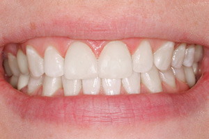 Художественная реставрация и чистка зубов, фото после
