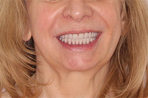 Восстановление зубов обеих челюстей