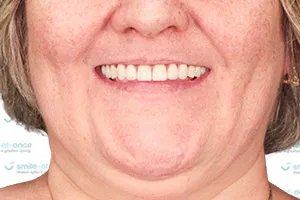Все зубы All-on-4 с постоянным протезом ПОСЛЕ