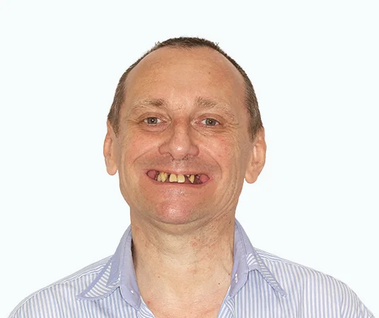 Фото: до имплантации при пародонтите