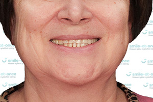 Новые зубы после All-on-6 на верхней челюсти До