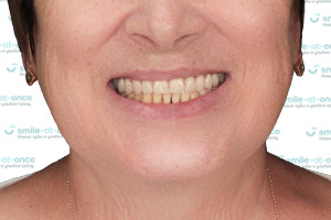 Новые зубы после All-on-6 на верхней челюсти После