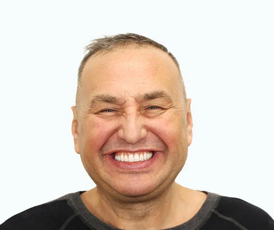 После восстановления зубов имплантацией all on 4