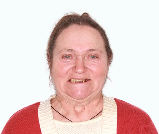 До восстановления зубов на нижней челюсти