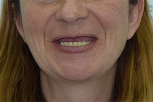 Полное восстановление верхней челюсти