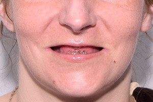 BASAL COMPLEX на обе челюсти - до