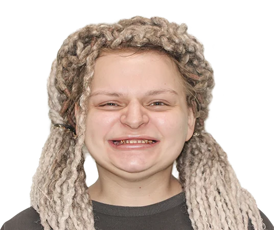 До имлантации взамен съемных зубных протезов